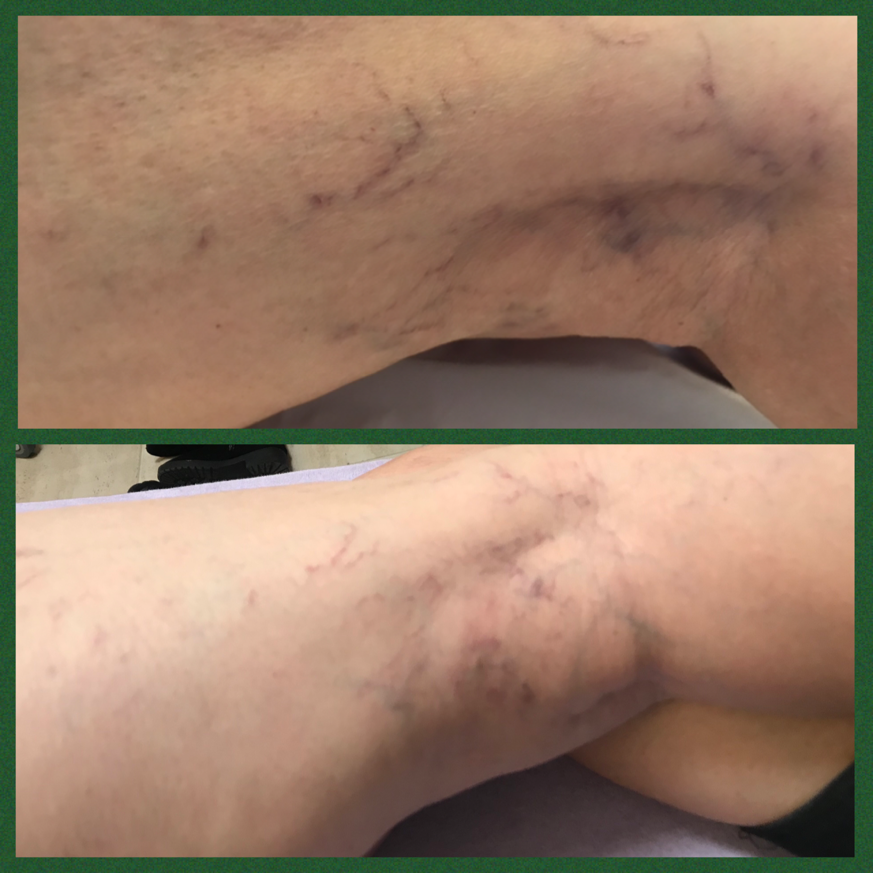 Sclerotherapy Essex Vein Removal