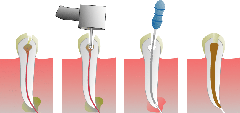 Root Canal Treatment in Southend-on-Sea