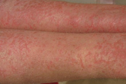Eczema and Dermatitis Southend Essex