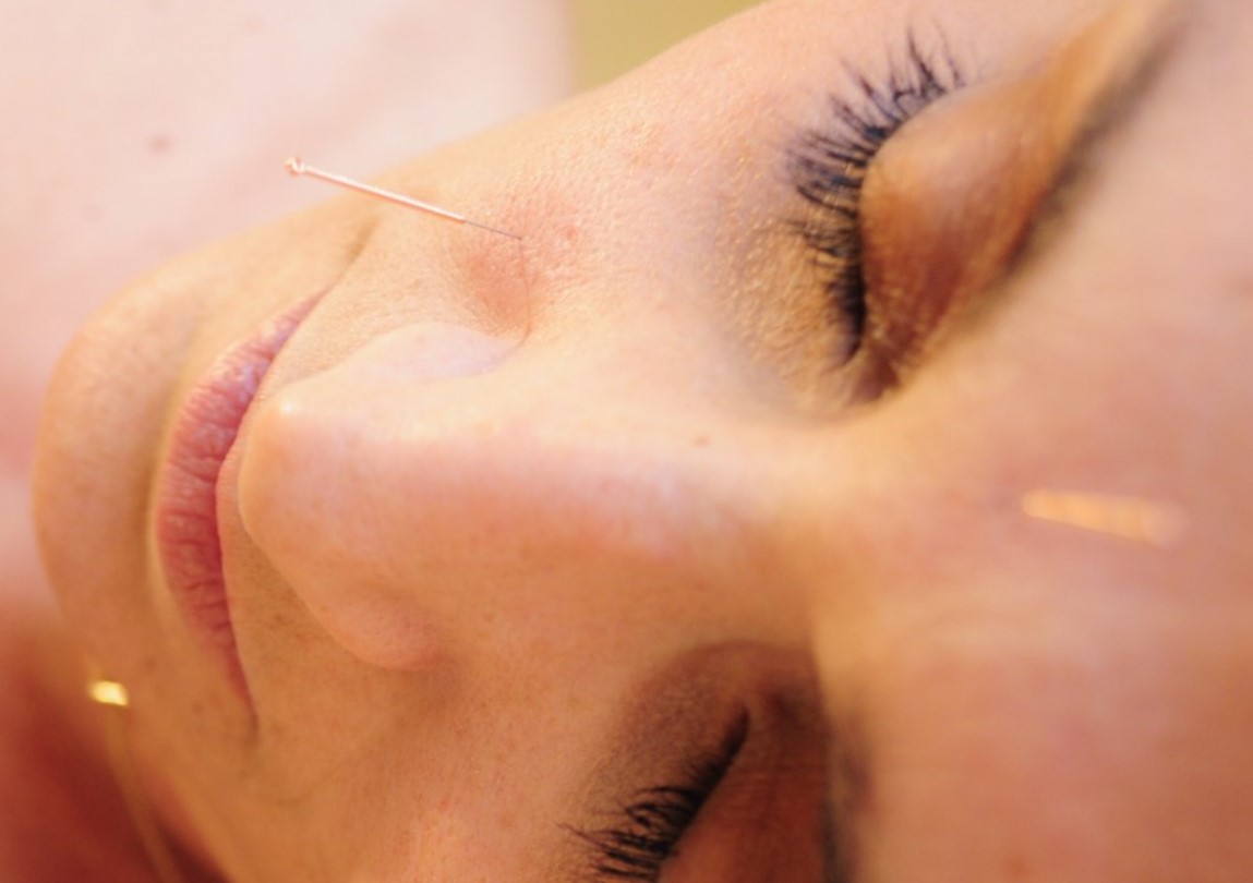 Facial Acupuncture Southend Essex