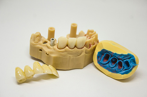 dental bridge