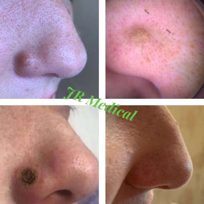 cryotherapy skin lesions