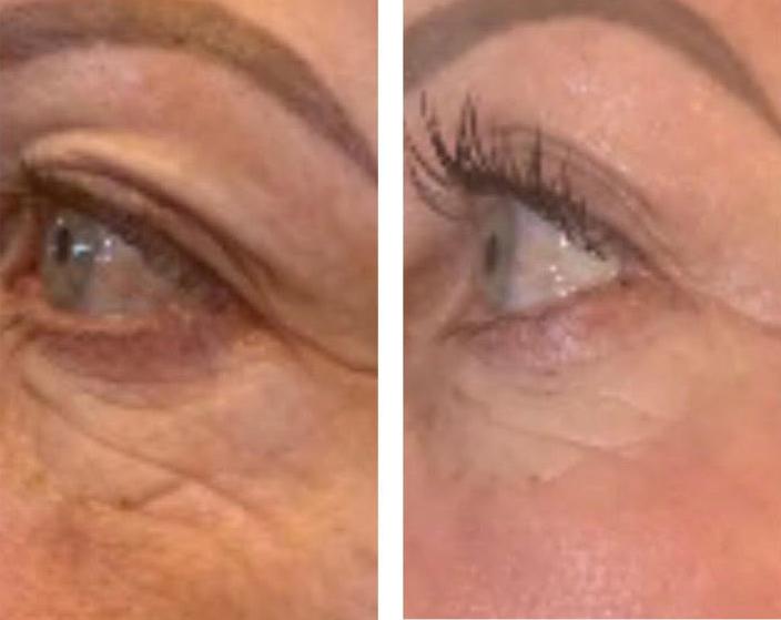 co2 eye lift