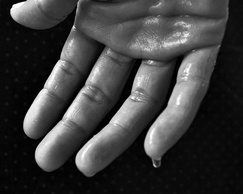 hand hyperhidrosis