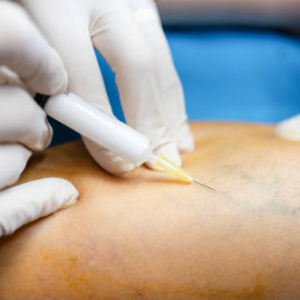 Sclerotherapy