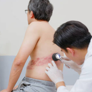 eczema