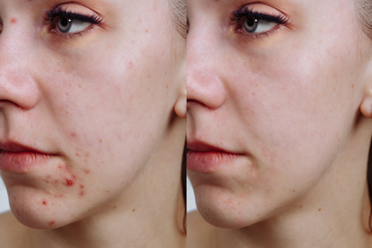 acne