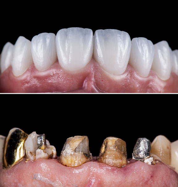 dental bridge