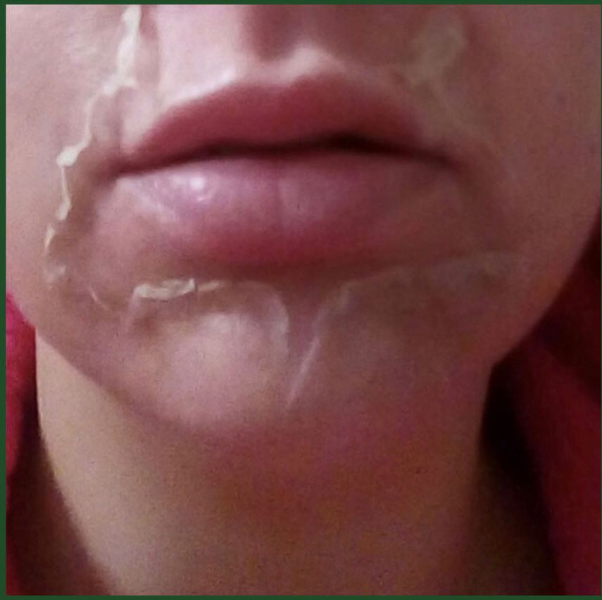 chemical peel