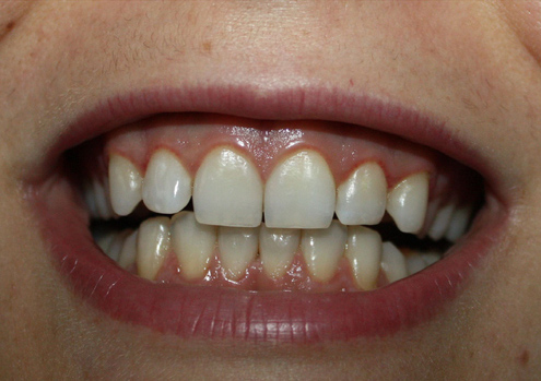 teeth cleaning