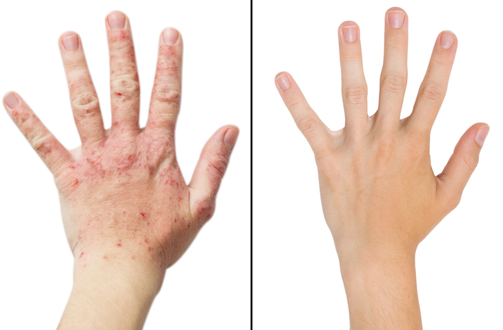 eczema