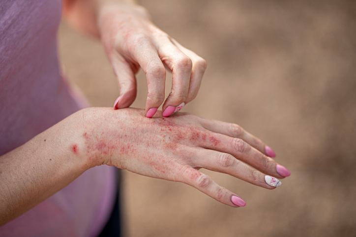 eczema