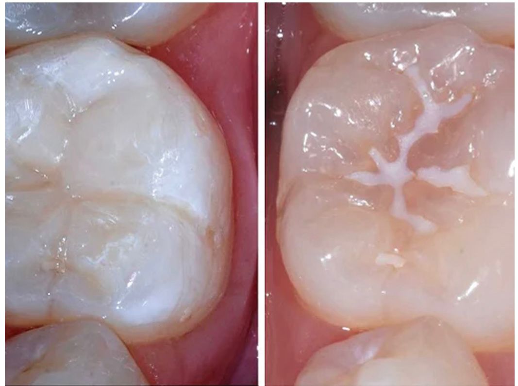 fissure sealant