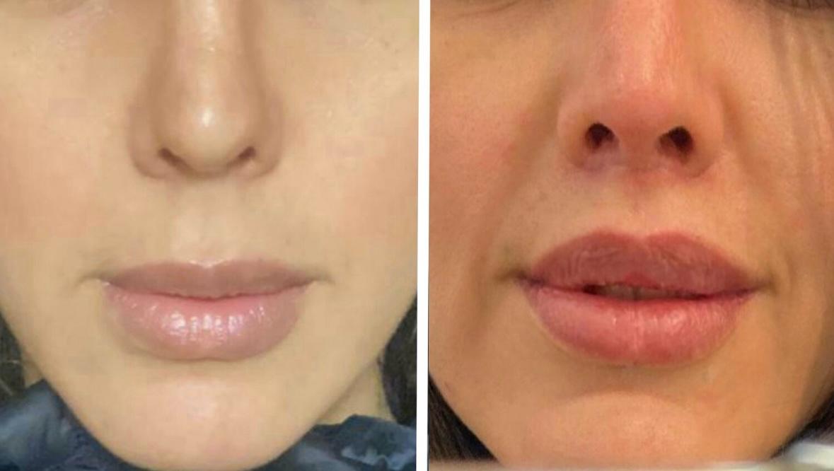 surgical lip lift