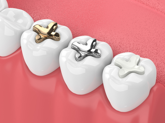 dental filling