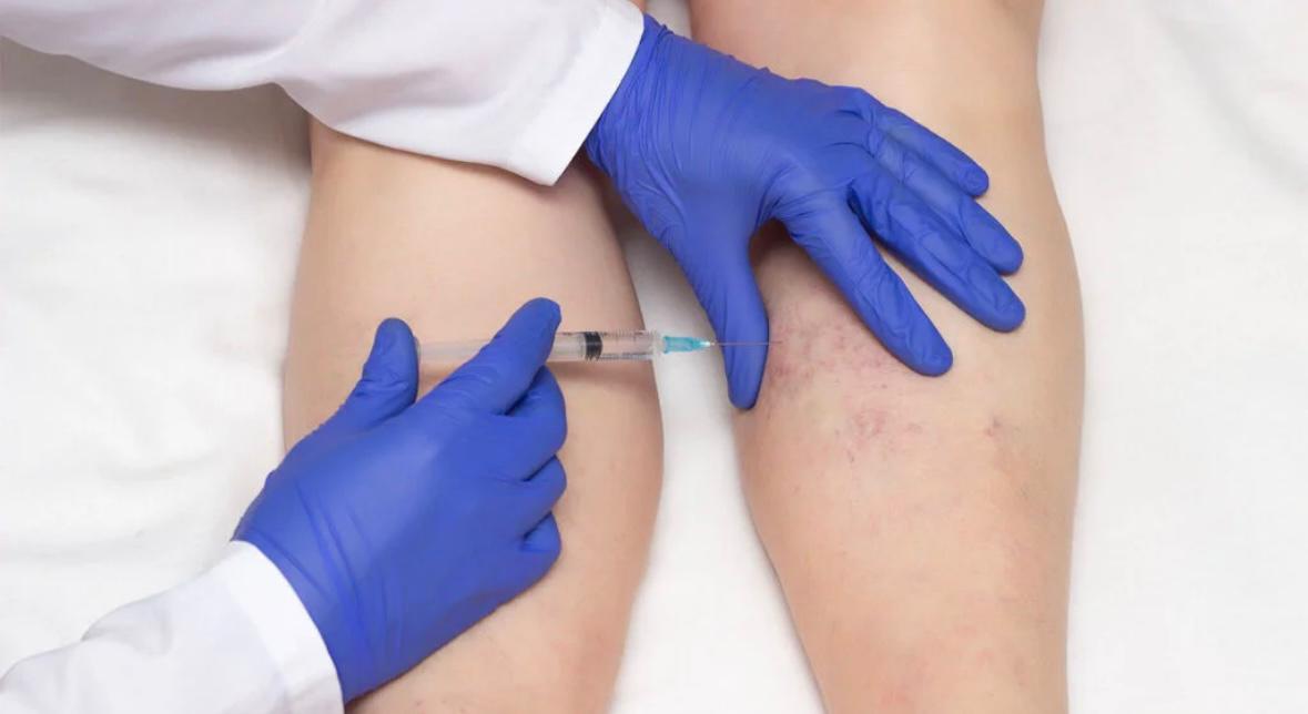 Sclerotherapy Thread Vein Treatment