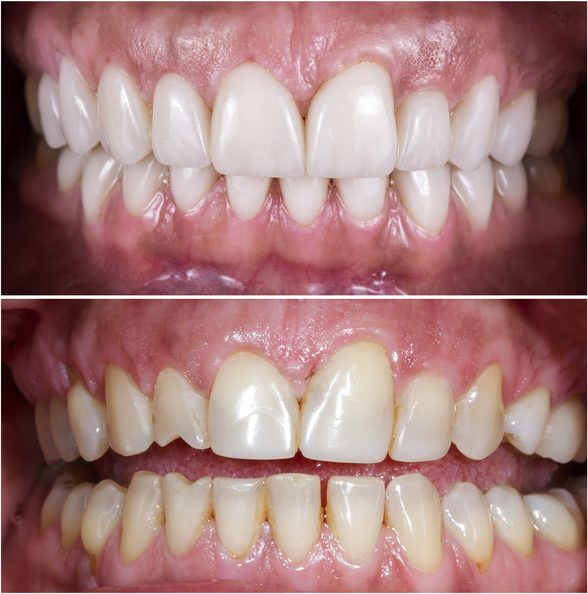 teeth whitening