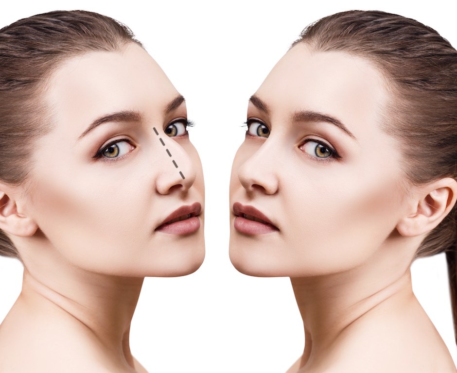 non-surgical rhinoplasty