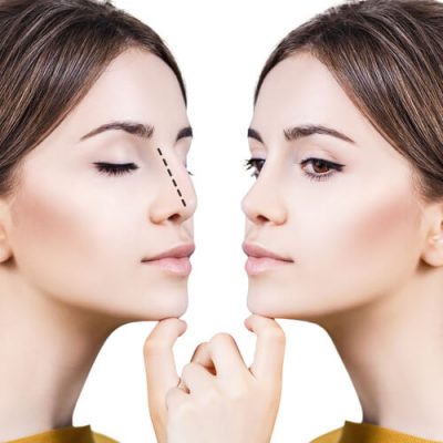 non-surgical rhinoplasty